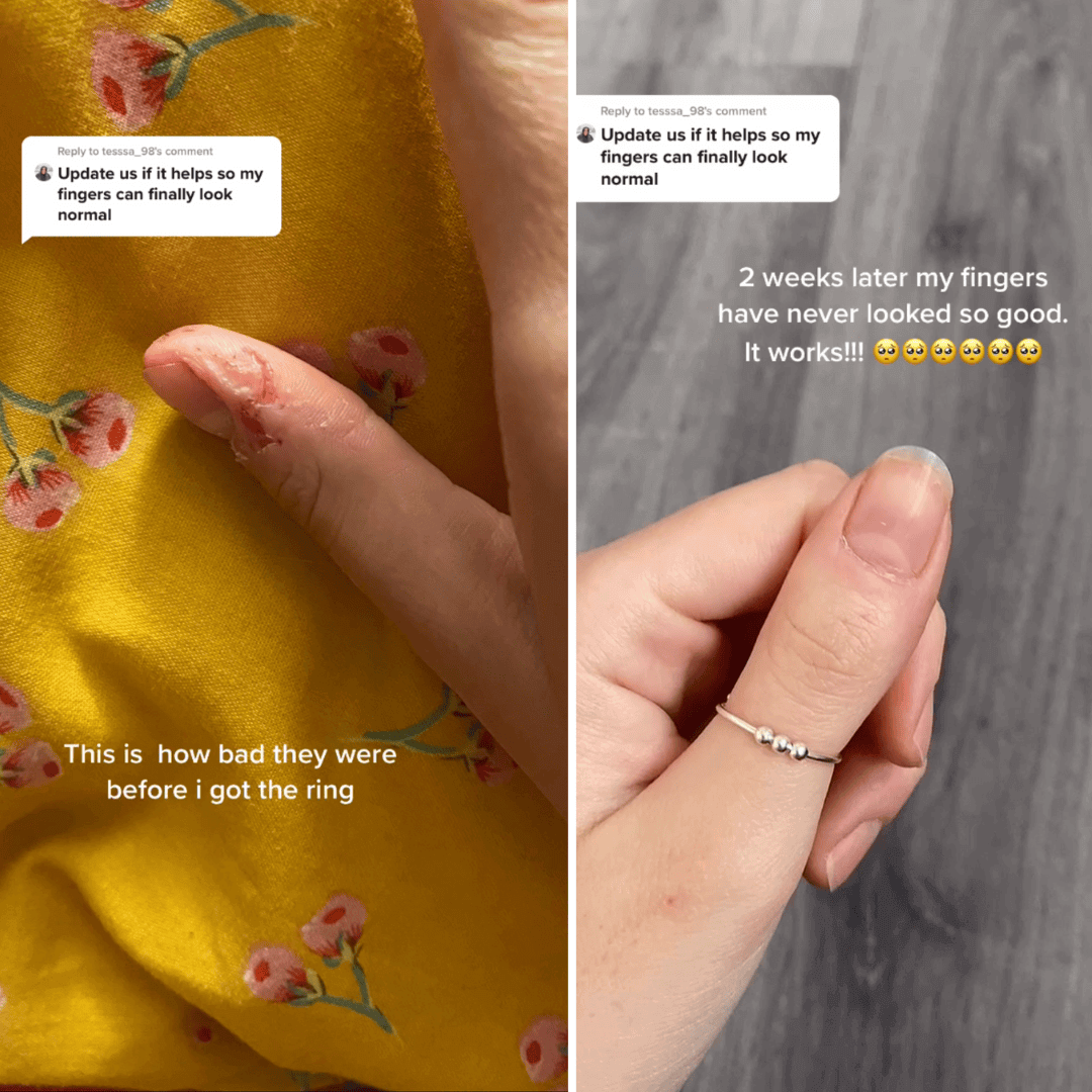 Before and after image of fingers, showcasing improvement after using the Fidget Beads Ring for anxiety relief.